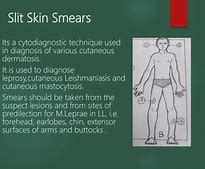 Slit Skin Smear Cara Bacanya Gimana